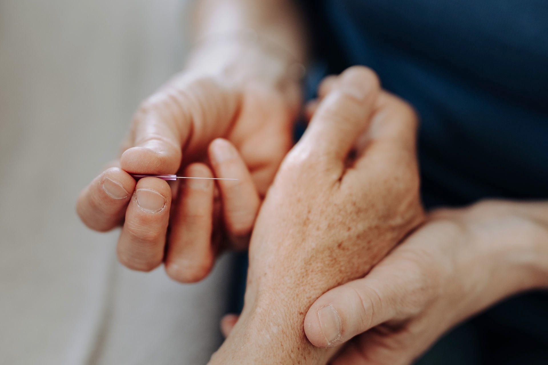 Akupunkturnadel setzen an einer Hand Akupunkturnadel setzen an einer Hand